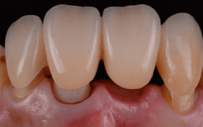 ENDODONCIA ENDODONCIA